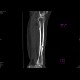Chronic osteomyelitis and bone squestration: CT - Computed tomography